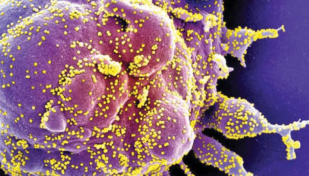 Colorized scanning electron micrograph of an apoptotic cell (purple) infected with SARS-COV-2 virus particles (yellow), also known as novel coronavirus, isolated from a patient’s sample.